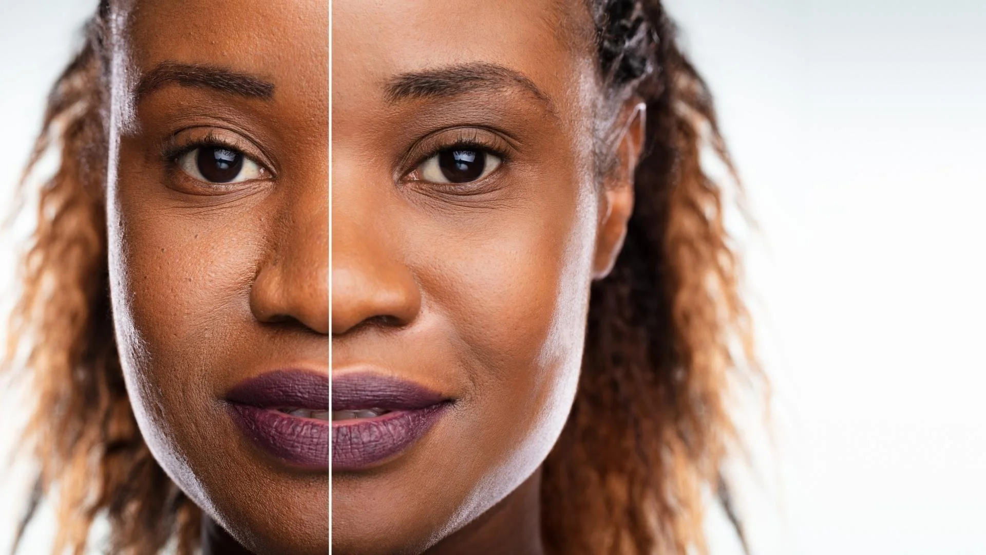 Microdermabrasion treatment